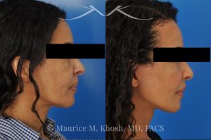 Photo of a patient before and after a procedure. Facelift - This delightful 57 year old desired a younger looking and natural enhancement of her face. Facelift surgery in New York was performed under local anesthesia as an office procedure. The before and after photos demonstrate her results 2 months after surgery. Notes the improved contour of the chin and jowls. The heavy-looking and squared appearing lower face has been transformed to a heart shaped lower face. The new and improved look is complementary and natural appearing. The patient is thrilled with her beautiful results. 
