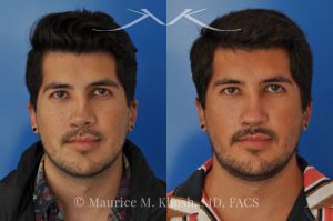 Photo of a patient before and after a procedure. Revision rhinoplasty for cleft lip nose deformity - This 24 year-old with congenital cleft lip nasal deformity had previously undergone surgery on his nose. As a result of that previous surgery the nose tip had become overly up-turned and the middle vault of the nose was pinched appearing. The right nostril base was depressed relative to the normal left side. Revision rhinoplasty in New York was performed with rib cartilage which was harvested from the patient's own chest. The 7 month results (on the left side) show a dramatic improvement in regards to the shape and position of the nasal tip, middle vault of the nose, and the position of the right nostril base. 