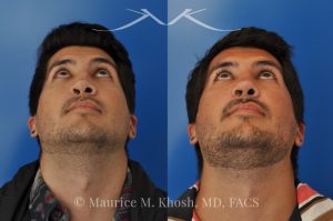 Photo of a patient before and after a procedure. Revision rhinoplasty for cleft lip nose deformity - This 24 year-old with congenital cleft lip nasal deformity had previously undergone surgery on his nose. As a result of that previous surgery the nose tip had become overly up-turned and the middle vault of the nose was pinched appearing. The right nostril base was depressed relative to the normal left side. Revision rhinoplasty in New York was performed with rib cartilage which was harvested from the patient's own chest. The 7 month results (on the left side) show a dramatic improvement in regards to the shape and position of the nasal tip, middle vault of the nose, and the position of the right nostril base. 