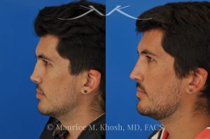 Photo of a patient before and after a procedure. Revision rhinoplasty for cleft lip nose deformity - This 24 year-old with congenital cleft lip nasal deformity had previously undergone surgery on his nose. As a result of that previous surgery the nose tip had become overly up-turned and the middle vault of the nose was pinched appearing. The right nostril base was depressed relative to the normal left side. Revision rhinoplasty in New York was performed with rib cartilage which was harvested from the patient's own chest. The 7 month results (on the left side) show a dramatic improvement in regards to the shape and position of the nasal tip, middle vault of the nose, and the position of the right nostril base. 