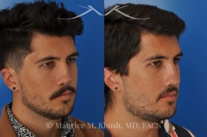 Photo of a patient before and after a procedure. Revision rhinoplasty for cleft lip nose deformity - This 24 year-old with congenital cleft lip nasal deformity had previously undergone surgery on his nose. As a result of that previous surgery the nose tip had become overly up-turned and the middle vault of the nose was pinched appearing. The right nostril base was depressed relative to the normal left side. Revision rhinoplasty in New York was performed with rib cartilage which was harvested from the patient's own chest. The 7 month results (on the left side) show a dramatic improvement in regards to the shape and position of the nasal tip, middle vault of the nose, and the position of the right nostril base. 