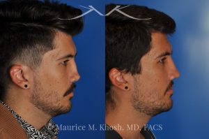 Photo of a patient before and after a procedure. Revision rhinoplasty for cleft lip nose deformity - This 24 year-old with congenital cleft lip nasal deformity had previously undergone surgery on his nose. As a result of that previous surgery the nose tip had become overly up-turned and the middle vault of the nose was pinched appearing. The right nostril base was depressed relative to the normal left side. Revision rhinoplasty in New York was performed with rib cartilage which was harvested from the patient's own chest. The 7 month results (on the left side) show a dramatic improvement in regards to the shape and position of the nasal tip, middle vault of the nose, and the position of the right nostril base. 