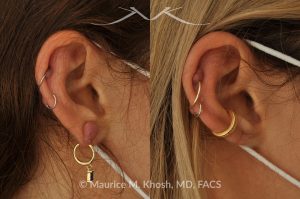 Photo of a patient before and after a procedure. Keloid of earlobe - This 40-year-old had developed a keloid in the right earlobe, after a piercing. The keloid was removed, leaving a very fine scar in the earlobe.