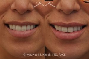 Photo of a patient before and after a procedure. Lip Augmentation - This 33-year-old young woman was interested in a beautiful and natural augmentation of her lips. She wanted more voluptuous and sexy lips without appearing puffy or over-done. Hyaluronic acid filler was used to give her a subtle but noticeable improvement.