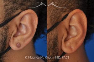 Photo of a patient before and after a procedure. Kleoid ear - This 38 year-old underwent excision of a left earlobe keloid. The post op pictures show an imperceptible scar after keloid removal.