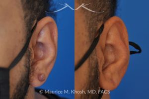 Photo of a patient before and after a procedure. Kleoid ear - This 38 year-old underwent excision of a left earlobe keloid. The post op pictures show an imperceptible scar after keloid removal.