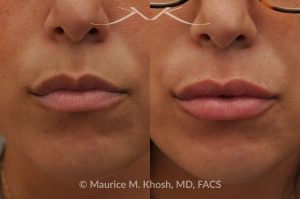 Photo of a patient before and after a procedure. Lip Augmentation - This 33-year-old young woman was interested in a beautiful and natural augmentation of her lips. She wanted more voluptuous and sexy lips without appearing puffy or over-done. Hyaluronic acid filler was used to give her a subtle but noticeable improvement.