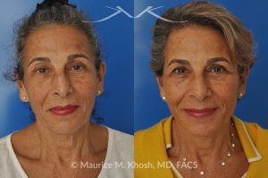 Photo of a patient before and after a procedure. Facelift and Neck lift - This delightful 68-year old underwent facelift and neck lift surgery to rejuvenate the lower face and neck area. The SMAS facelift allowed resolution of her jowls and sagging cheeks. The neck lift procedure helped to improve the sagging neck, and the skin hanging in the neck. She is ecstatic with the beautiful and natural results of her facelift and neck lift.