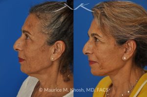 Photo of a patient before and after a procedure. Facelift and Neck lift - This delightful 68-year old underwent facelift and neck lift surgery to rejuvenate the lower face and neck area. The SMAS facelift allowed resolution of her jowls and sagging cheeks. The neck lift procedure helped to improve the sagging neck, and the skin hanging in the neck. She is ecstatic with the beautiful and natural results of her facelift and neck lift.