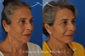 Photo of a patient before and after a procedure. Facelift and Neck lift - This delightful 68-year old underwent facelift and neck lift surgery to rejuvenate the lower face and neck area. The SMAS facelift allowed resolution of her jowls and sagging cheeks. The neck lift procedure helped to improve the sagging neck, and the skin hanging in the neck. She is ecstatic with the beautiful and natural results of her facelift and neck lift.