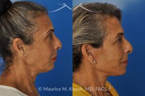 Photo of a patient before and after a procedure. Facelift and Neck lift - This delightful 68-year old underwent facelift and neck lift surgery to rejuvenate the lower face and neck area. The SMAS facelift allowed resolution of her jowls and sagging cheeks. The neck lift procedure helped to improve the sagging neck, and the skin hanging in the neck. She is ecstatic with the beautiful and natural results of her facelift and neck lift.