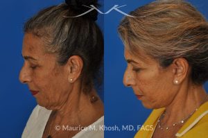 Photo of a patient before and after a procedure. Facelift and Neck lift - This delightful 68-year old underwent facelift and neck lift surgery to rejuvenate the lower face and neck area. The SMAS facelift allowed resolution of her jowls and sagging cheeks. The neck lift procedure helped to improve the sagging neck, and the skin hanging in the neck. She is ecstatic with the beautiful and natural results of her facelift and neck lift.