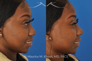 Photo of a patient before and after a procedure. Liquid rhinoplasty - This delightful patient was interested in improving the appearance of her nose without surgery. She disliked the droopy tip which became even more droopy when she smiled. She wanted more definition in the tip. Filler injections allowed us to improve the nasal tip position and shape, while a small injection into the bridge of the nose helped to eliminate the small hump. The patient was ecstatic with the results of her liquid rhinoplasty. 