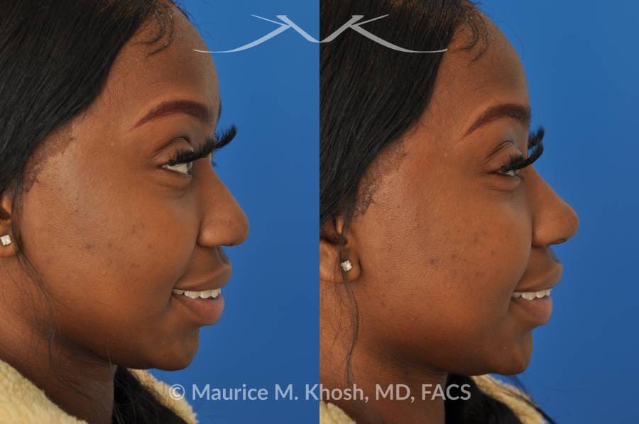 Female patient before and after liquid rhinoplasty non-surgical procedure