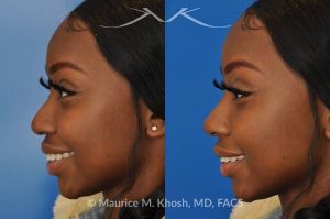 Photo of a patient before and after a procedure. Liquid rhinoplasty - This delightful patient was interested in improving the appearance of her nose without surgery. She disliked the droopy tip which became even more droopy when she smiled. She wanted more definition in the tip. Filler injections allowed us to improve the nasal tip position and shape, while a small injection into the bridge of the nose helped to eliminate the small hump. The patient was ecstatic with the results of her liquid rhinoplasty. 