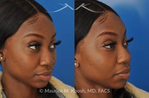 Photo of a patient before and after a procedure. Liquid rhinoplasty - This delightful patient was interested in improving the appearance of her nose without surgery. She disliked the droopy tip which became even more droopy when she smiled. She wanted more definition in the tip. Filler injections allowed us to improve the nasal tip position and shape, while a small injection into the bridge of the nose helped to eliminate the small hump. The patient was ecstatic with the results of her liquid rhinoplasty. 