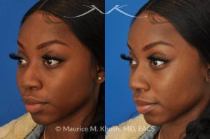 Photo of a patient before and after a procedure. Liquid rhinoplasty - This delightful patient was interested in improving the appearance of her nose without surgery. She disliked the droopy tip which became even more droopy when she smiled. She wanted more definition in the tip. Filler injections allowed us to improve the nasal tip position and shape, while a small injection into the bridge of the nose helped to eliminate the small hump. The patient was ecstatic with the results of her liquid rhinoplasty. 