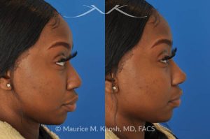 Photo of a patient before and after a procedure. Liquid rhinoplasty - This delightful patient was interested in improving the appearance of her nose without surgery. She disliked the droopy tip which became even more droopy when she smiled. She wanted more definition in the tip. Filler injections allowed us to improve the nasal tip position and shape, while a small injection into the bridge of the nose helped to eliminate the small hump. The patient was ecstatic with the results of her liquid rhinoplasty. 