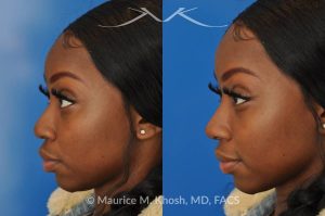 Photo of a patient before and after a procedure. Liquid rhinoplasty - This delightful patient was interested in improving the appearance of her nose without surgery. She disliked the droopy tip which became even more droopy when she smiled. She wanted more definition in the tip. Filler injections allowed us to improve the nasal tip position and shape, while a small injection into the bridge of the nose helped to eliminate the small hump. The patient was ecstatic with the results of her liquid rhinoplasty. 