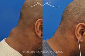 Photo of a patient before and after a procedure. Lipoma - 44 year old with recurrent lipoma in the posterior aspect of the neck requested lipoma removal in our New York office. The right side photos demonstrate the successful outcome of surgery 4 months post op.