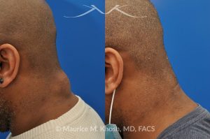 Photo of a patient before and after a procedure. Lipoma - 44 year old with recurrent lipoma in the posterior aspect of the neck requested lipoma removal in our New York office. The right side photos demonstrate the successful outcome of surgery 4 months post op.