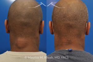 Photo of a patient before and after a procedure. Lipoma - 44 year old with recurrent lipoma in the posterior aspect of the neck requested lipoma removal in our New York office. The right side photos demonstrate the successful outcome of surgery 4 months post op.