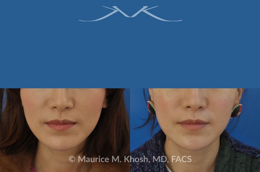 A man's face with a blue strip of eyes - Botox For Masseter Reduction