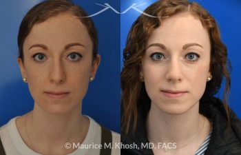 Female patient before and after Nasal hump reduction and tip elevation