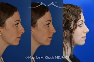 Photo of a patient before and after a procedure. Nasal hump reduction and tip elevation - This 27 year old requested rhinoplasty in New York to address a large nasal hump and to improve the nasal tip in a subtle and natural manner. The images show her before and after photos 6 months after surgery. The last two images show our computer simulation of the appearance of the bridge of her nose, in the middle images. Note the similarity of the simulation photos to the final outcome. 
