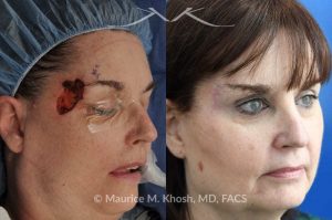 Photo of a patient before and after a procedure. Mohs - This delightful patient was referred for repair of a Moh's defect following excision of a basal cell cancer from the right temple and forehead. Repair was accomplished with a flap repair. The post op results demonstrate her at 6 months following repair. 