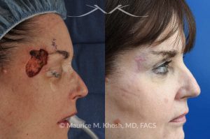 Photo of a patient before and after a procedure. Mohs - This delightful patient was referred for repair of a Moh's defect following excision of a basal cell cancer from the right temple and forehead. Repair was accomplished with a flap repair. The post op results demonstrate her at 6 months following repair. 