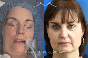 Photo of a patient before and after a procedure. Mohs - This delightful patient was referred for repair of a Moh's defect following excision of a basal cell cancer from the right temple and forehead. Repair was accomplished with a flap repair. The post op results demonstrate her at 6 months following repair. 