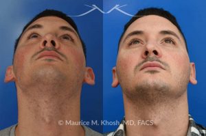 Photo of a patient before and after a procedure. Otoplasty - This 26 year-old requested consultation regarding earpinnig and reducing the size of the left ear. He found both ears to be sticking out too far, and noted the left ear to be larger than the right side. Otopalsty was performed under local anesthesia in our Manhattan office. Both ears were pushed closer to the scalp. The left ear was shortened.