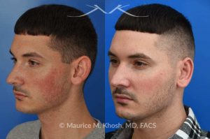 Photo of a patient before and after a procedure. Otoplasty - This 26 year-old requested consultation regarding earpinnig and reducing the size of the left ear. He found both ears to be sticking out too far, and noted the left ear to be larger than the right side. Otopalsty was performed under local anesthesia in our Manhattan office. Both ears were pushed closer to the scalp. The left ear was shortened.