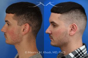 Photo of a patient before and after a procedure. Otoplasty - This 26 year-old requested consultation regarding earpinnig and reducing the size of the left ear. He found both ears to be sticking out too far, and noted the left ear to be larger than the right side. Otopalsty was performed under local anesthesia in our Manhattan office. Both ears were pushed closer to the scalp. The left ear was shortened.