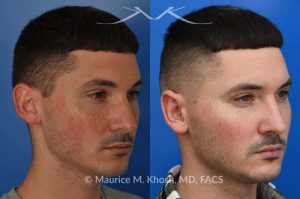 Photo of a patient before and after a procedure. Otoplasty - This 26 year-old requested consultation regarding earpinnig and reducing the size of the left ear. He found both ears to be sticking out too far, and noted the left ear to be larger than the right side. Otopalsty was performed under local anesthesia in our Manhattan office. Both ears were pushed closer to the scalp. The left ear was shortened.