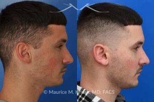 Photo of a patient before and after a procedure. Otoplasty - This 26 year-old requested consultation regarding earpinnig and reducing the size of the left ear. He found both ears to be sticking out too far, and noted the left ear to be larger than the right side. Otopalsty was performed under local anesthesia in our Manhattan office. Both ears were pushed closer to the scalp. The left ear was shortened.