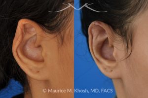 Photo of a patient before and after a procedure. Otoplasty - 26 year old had developed upper ear infection and collapse following a piercing gone wrong. Cartilage from another part of the ear was used to rebuild the upper rim of the external ear