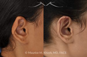Photo of a patient before and after a procedure. Otoplasty - 26 year old had developed upper ear infection and collapse following a piercing gone wrong. Cartilage from another part of the ear was used to rebuild the upper rim of the external ear