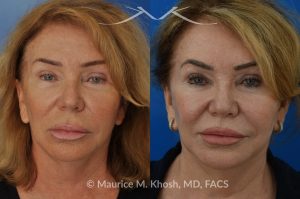 Photo of a patient before and after a procedure. Lip Lift - This 65 year old desired a rejuvenated upper lip. She noted the upper lip to be excessively long, covering her upper teeth and giving her a tired and aged appearance. Lip fillers only exacerbated the problem. The post op photos on the right side show her results at 6 months after surgery.