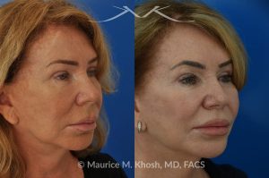 Photo of a patient before and after a procedure. Lip Lift - This 65 year old desired a rejuvenated upper lip. She noted the upper lip to be excessively long, covering her upper teeth and giving her a tired and aged appearance. Lip fillers only exacerbated the problem. The post op photos on the right side show her results at 6 months after surgery.