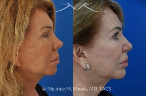 Photo of a patient before and after a procedure. Lip Lift - This 65 year old desired a rejuvenated upper lip. She noted the upper lip to be excessively long, covering her upper teeth and giving her a tired and aged appearance. Lip fillers only exacerbated the problem. The post op photos on the right side show her results at 6 months after surgery.