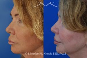 Photo of a patient before and after a procedure. Lip Lift - This 65 year old desired a rejuvenated upper lip. She noted the upper lip to be excessively long, covering her upper teeth and giving her a tired and aged appearance. Lip fillers only exacerbated the problem. The post op photos on the right side show her results at 6 months after surgery.