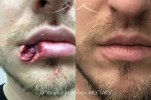 Photo of a patient before and after a procedure. Lower lip repair after dog bite injury - This gentleman sustained a dog bite injury resulting in loss of part of his lower lip. The injured site was repaired in the emergency room. He then visited us for improvement of a depressed and notched appearing lip scar. The right side picture shows the results of the scar revision for his lip, resulting in a minimally noticeable vertical scar of the lip. 