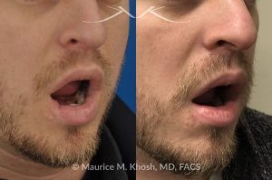 Photo of a patient before and after a procedure. Scar revision of lower lip - This gentleman sustained a dog bite injury resulting in loss of part of his lower lip. The injured site was repaired in the emergency room. He then visited us for improvement of a depressed and notched appearing lip scar. The right side picture shows the results of the scar revision for his lip, resulting in a minimally noticeable vertical scar of the lip. 