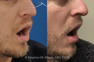Photo of a patient before and after a procedure. Scar revision of lower lip - This gentleman sustained a dog bite injury resulting in loss of part of his lower lip. The injured site was repaired in the emergency room. He then visited us for improvement of a depressed and notched appearing lip scar. The right side picture shows the results of the scar revision for his lip, resulting in a minimally noticeable vertical scar of the lip. 