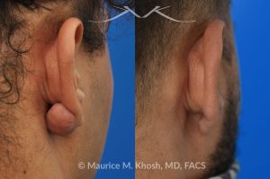 Photo of a patient before and after a procedure. Keloid of earlobe - This 30 year old complained of developing a keloid scar on his earlobe following ear piercing. Keloid surgery in Manhattan office, followed by a series of injections resulted in complete restoration of the natural appearing earlobe.