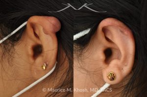 Photo of a patient before and after a procedure. Keloid scar of the upper ear - This delightful patient had formed a keloid after an ear piercing in the upper part of her ear. Keloid removal allowed restoration of a normal appearing ear. She is ecstatic with her results.