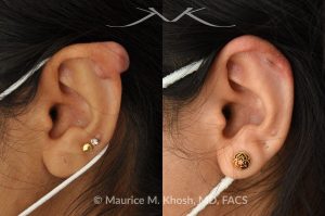 Photo of a patient before and after a procedure. Keloid scar of the upper ear - This delightful patient had formed a keloid after an ear piercing in the upper part of her ear. Keloid removal allowed restoration of a normal appearing ear. She is ecstatic with her results.