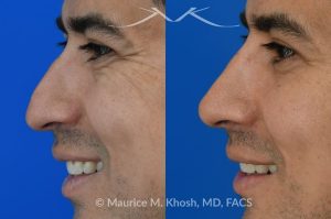 Photo of a patient before and after a procedure. Liquid rhinoplasty - This delightful patient disliked the nasal hump and droopy nasal tip. He was not ready for a surgical rhinoplasty. We performed liquid rhinoplasty in New York to elevate his nasal tip and straighten the nasal hump. Note that the nose tip does not droop even when he smiles. 